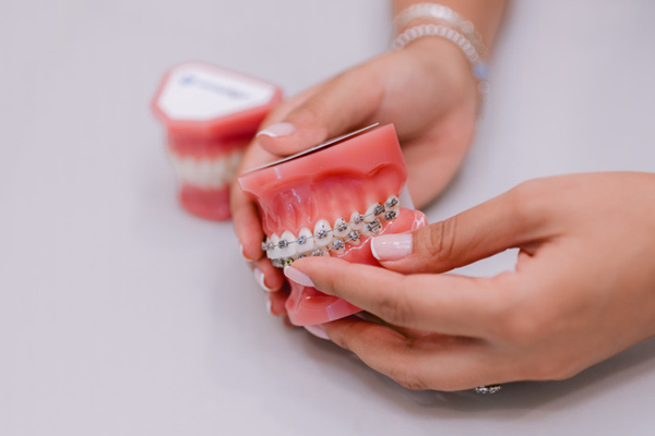 Close-up of a smiling lips with ceramic braces, showcasing straight white teeth and a natural pink lip color